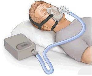 I'm Looking for a FREE sleep apnea machine