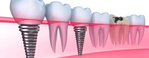 Restore Missing Teeth with Dental Implants SERVICES