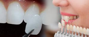 Dental Veneers to Fix Chipped Discolored Front Teeth SERVICES