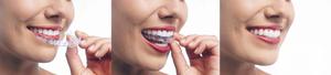 A Straighter Smile with Invisalign SERVICES