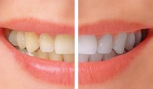 Teeth Whitening Treatments and Costs SERVICES