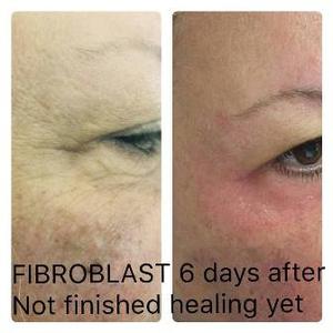 Fibroblast Plasmalift Wrinkle removal SERVICES