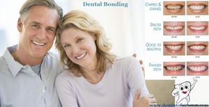 Tooth Bonding Auburn Wa | Affordable cosmetic dentistry